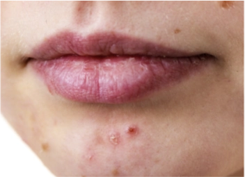 Tratamento para Acne